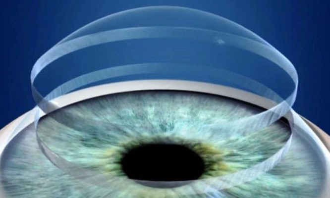 پیوند قرنیه